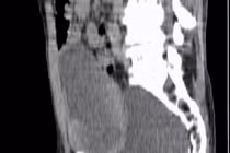 Phẫu thuật nội soi giúp bệnh nhân lớn tuổi thoát khỏi tiểu khó 