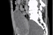 Phẫu thuật nội soi giúp bệnh nhân lớn tuổi thoát khỏi tiểu khó 