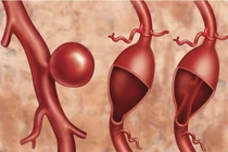 Kiểm tra phình động mạch chủ chỉ cần động tác đơn giản