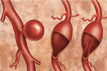 Kiểm tra phình động mạch chủ chỉ cần động tác đơn giản