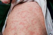 Cảnh báo trẻ nhỏ bị phát ban nguy hiểm dễ nhầm lẫn