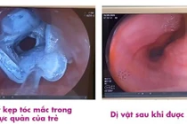 Trẻ 5 tuổi nuốt kẹp tóc, nguy hiểm đến tính mạng được xử lý thành công