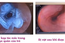 Trẻ 5 tuổi nuốt kẹp tóc, nguy hiểm đến tính mạng được xử lý thành công