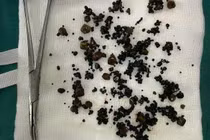 Gắp hàng trăm viên sỏi trong túi mật hai ngăn hiếm gặp