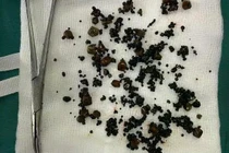 Gắp hàng trăm viên sỏi trong túi mật hai ngăn hiếm gặp