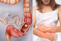 Phát hiện, điều trị tắc ruột do bã thức ăn bằng phương pháp nội soi