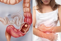 Phát hiện, điều trị tắc ruột do bã thức ăn bằng phương pháp nội soi