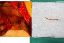 Liên tiếp 3 ca thủng nội tạng do xương cá