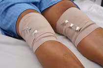 Dùng "keo tự thân” hỗ trợ tái tạo sụn khớp cho nam bệnh nhân