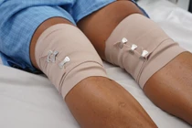 Dùng "keo tự thân” hỗ trợ tái tạo sụn khớp cho nam bệnh nhân