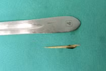 Cứu sống người đàn ông bị xương cá đâm thủng ruột non nguy kịch