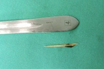 Cứu sống người đàn ông bị xương cá đâm thủng ruột non nguy kịch