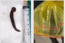 Con đỉa chui vào niệu đạo một nam giới khi đang làm đồng