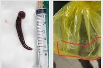 Con đỉa chui vào niệu đạo một nam giới khi đang làm đồng