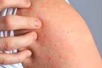 Người dân bị ghẻ, nấm... tăng mạnh sau mưa lũ