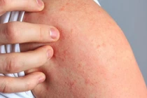 Người dân bị ghẻ, nấm... tăng mạnh sau mưa lũ