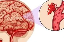 Phát hiện kịp thời huyết khối tĩnh mạch não giúp người bệnh hồi phục nhanh