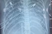 Kỹ thuật Hybrid ECMO cứu sống bệnh nhân sốc nhiễm trùng ở Nghệ An