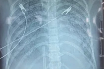 Kỹ thuật Hybrid ECMO cứu sống bệnh nhân sốc nhiễm trùng ở Nghệ An