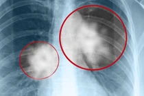 Phát hiện sớm nấm phổi xâm lấn để giảm nguy cơ tử vong