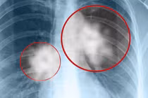 Phát hiện sớm nấm phổi xâm lấn để giảm nguy cơ tử vong