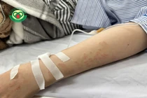 Nữ bệnh nhân ở Hải Phòng nhiễm 4 loại ký sinh trùng