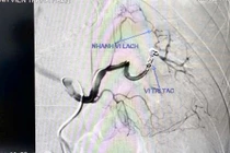 Bệnh nhân trẻ thoát chết sau biến cố bị vỡ giả phình động mạch lách