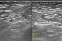 Phát hiện sớm ung thư vú ở người cao tuổi nhờ xét nghiệm giải phẫu bệnh