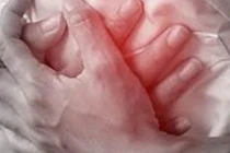 Phẫu thuật thành công cho nam bệnh nhân 44 tuổi bị nhồi máu cơ tim cấp