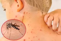 Hà Nội có 161 ca mắc sốt xuất huyết mới trong tuần qua