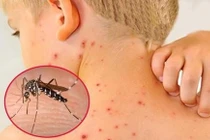 Hà Nội có 161 ca mắc sốt xuất huyết mới trong tuần qua