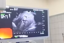 Nội soi siêu âm – chìa khóa phát hiện sớm ung thư, bệnh lý tiêu hóa