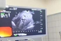 Nội soi siêu âm – chìa khóa phát hiện sớm ung thư, bệnh lý tiêu hóa