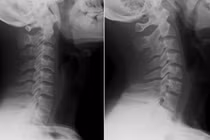 Nam thanh niên bàng hoàng khi biết mắc hội chứng "cổ thẳng" 