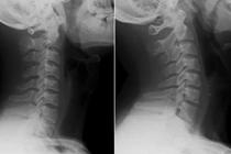 Nam thanh niên bàng hoàng khi biết mắc hội chứng "cổ thẳng" 