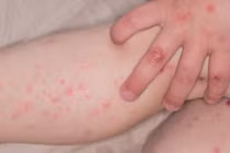 Số ca tay chân miệng tại TPHCM tăng hơn 240% so với cùng kỳ năm ngoái. Ảnh minh họa: TL/Nguồn thesaigontimes.vn