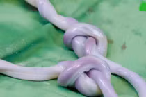 Bé trai chào đời khỏe mạnh sau ca sinh hiếm gặp dây rốn bị thắt hai nút