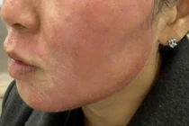 Hỏng mặt vì làm đẹp cấp tốc ở quán gội đầu