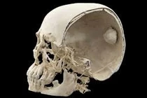 Người phụ nữ có khối u nền sọ khổng lồ tại “vị trí cấm kỵ” 