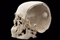 Người phụ nữ có khối u nền sọ khổng lồ tại “vị trí cấm kỵ” 