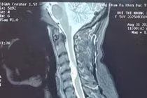 Người phụ nữ ở Phú Thọ mắc khối u màng tủy sống vùng cổ 