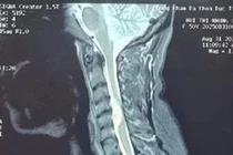 Người phụ nữ ở Phú Thọ mắc khối u màng tủy sống vùng cổ 