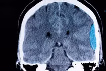 Cảnh báo đau đầu đột ngột có thể là dấu hiệu xuất huyết não