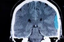 Cảnh báo đau đầu đột ngột có thể là dấu hiệu xuất huyết não