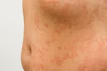 Cảnh báo bệnh lý da liễu mùa lạnh, cách phòng tránh