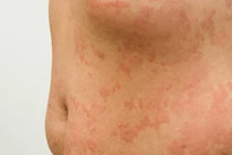 Cảnh báo bệnh lý da liễu mùa lạnh, cách phòng tránh