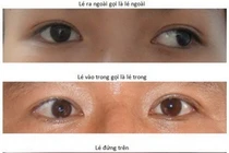 Lạm dụng thiết bị điện tử khiến tình trạng mắt lác gia tăng