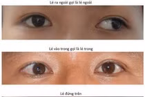 Lạm dụng thiết bị điện tử khiến tình trạng mắt lác gia tăng