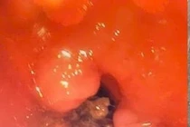 Cụ bà 84 tuổi suy hô hấp nguy kịch do hóc xương cá