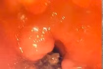 Cụ bà 84 tuổi suy hô hấp nguy kịch do hóc xương cá